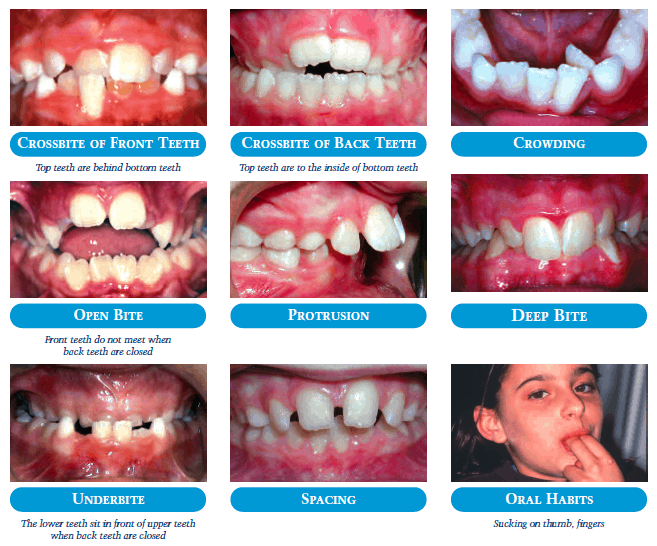 Common Problems - Kids Orthodontics