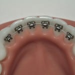 Lingual Braces