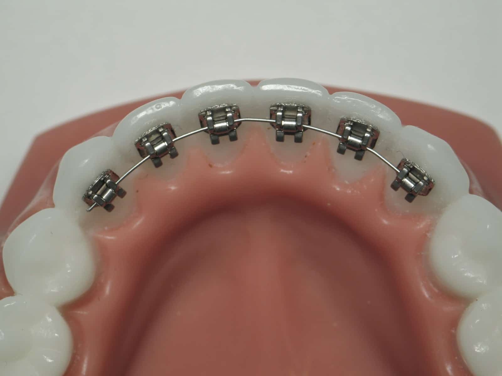 FAQ About Lingual Braces