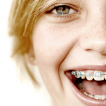 oral hygiene with braces