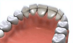 orthodontic retention phase