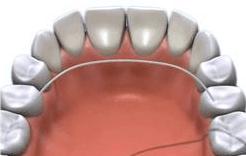 orthodontic retainer phase