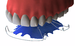 orthodontic retainer phase