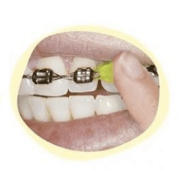 life with braces - gishy goo
