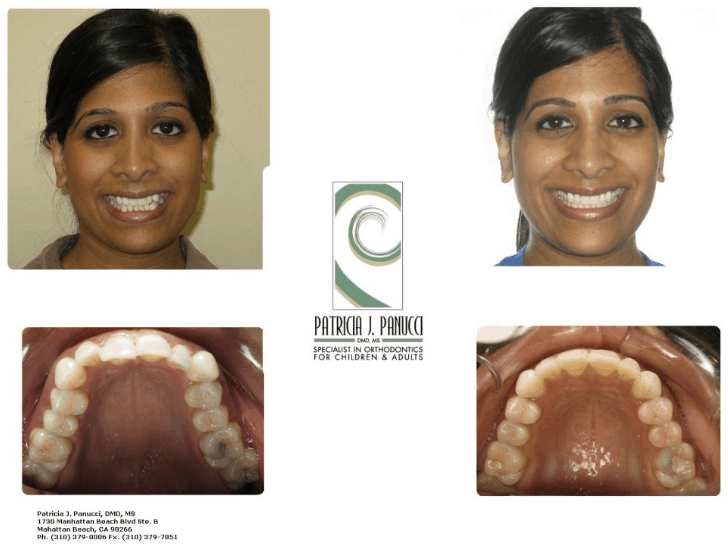 Invisalign Before & After Tina 2