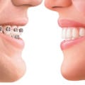 Invisalign v Braces