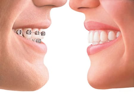 Invisalign v Braces