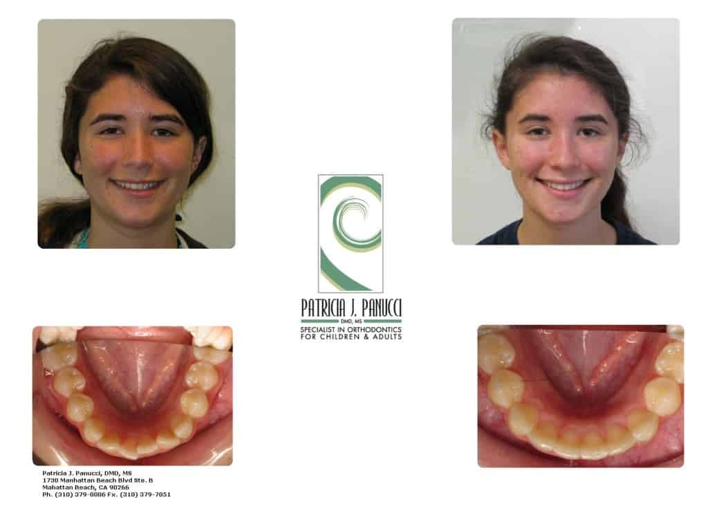 Invisalign Before & After
