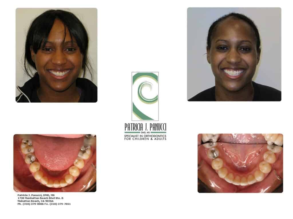 Invisalign Before and After