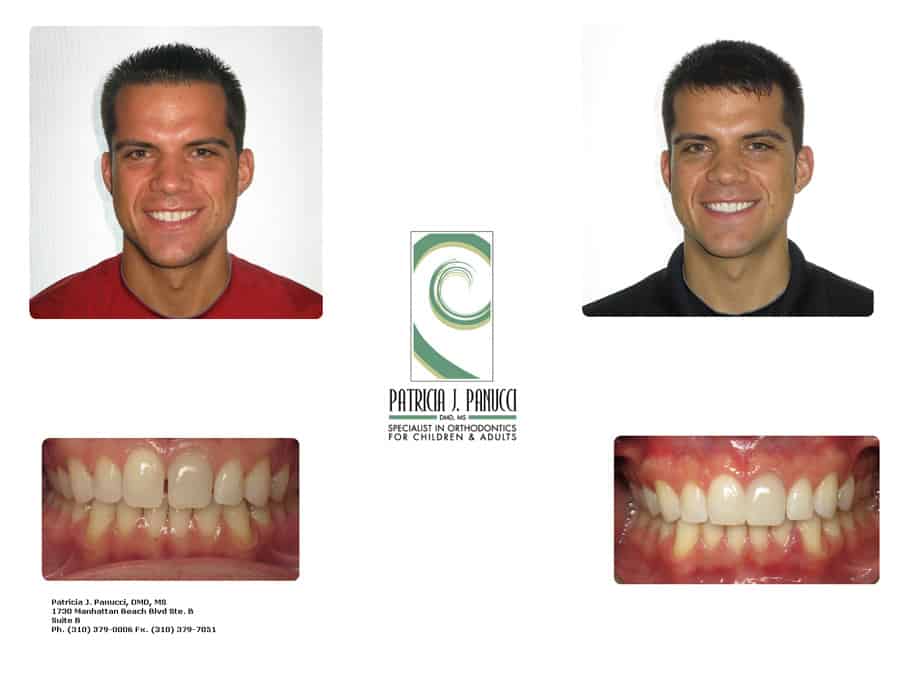 Adam W before and after orthodontic invisalign treatment