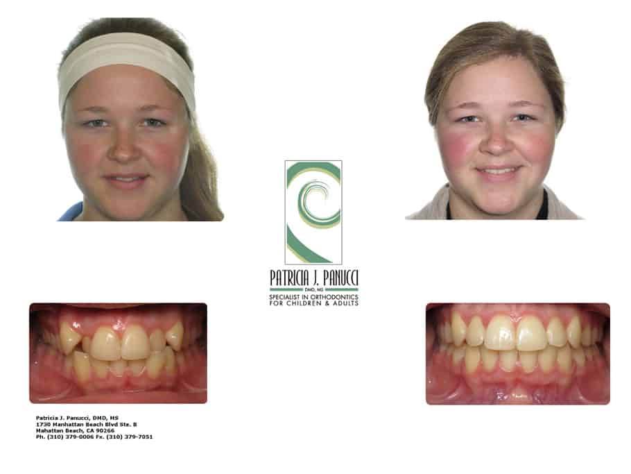 Cynthia M before and after orthodontic invisalign treatment