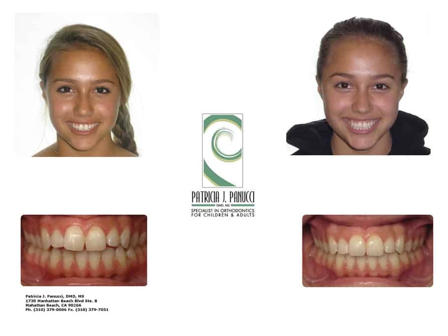 Emma O before and after orthodontic invisalign treatment