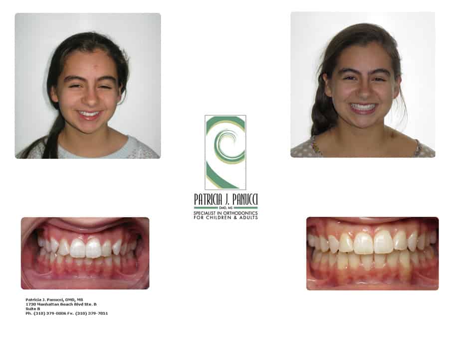 Gabriela before and after orthodontic invisalign treatment