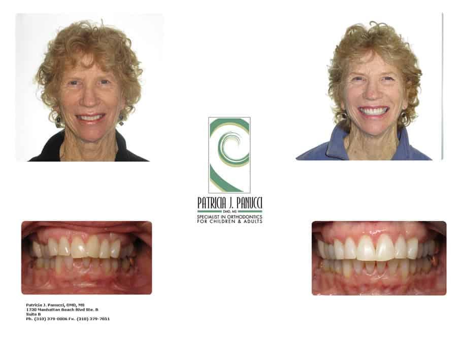 Judy B before and after orthodontic invisalign treatment
