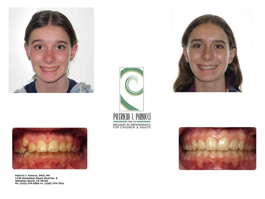 Julia M before and after orthodontic invisalign treatment