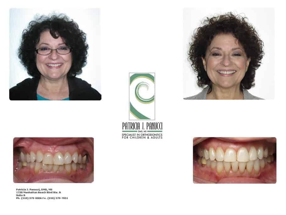 Laurel I before and after orthodontic invisalign treatment
