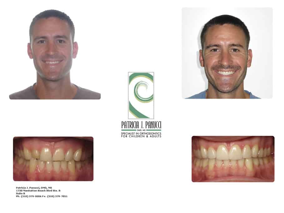 Mark A before and after orthodontic invisalign treatment