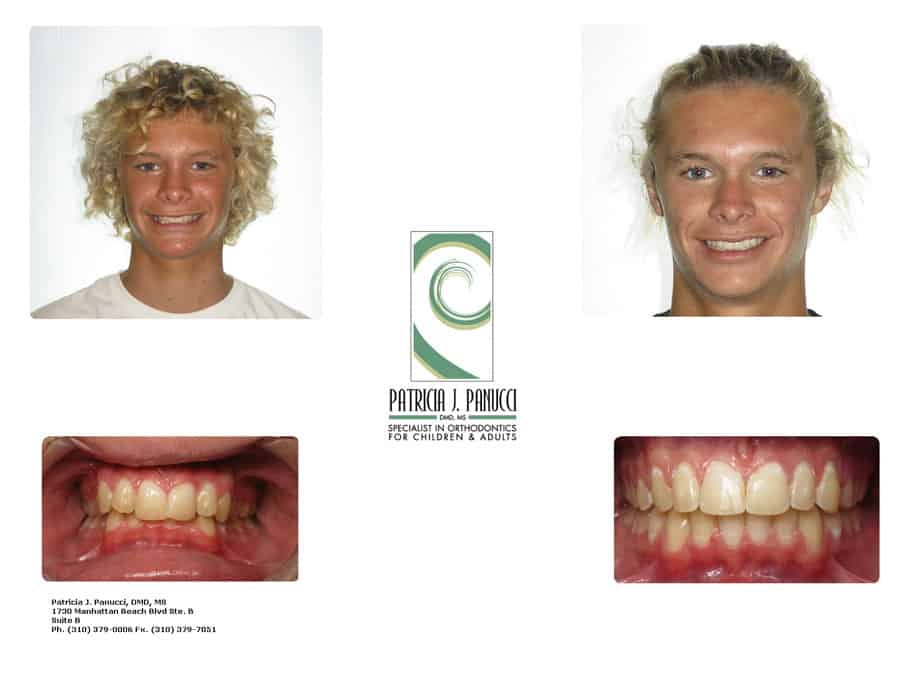 Matt H before and after orthodontic invisalign treatment