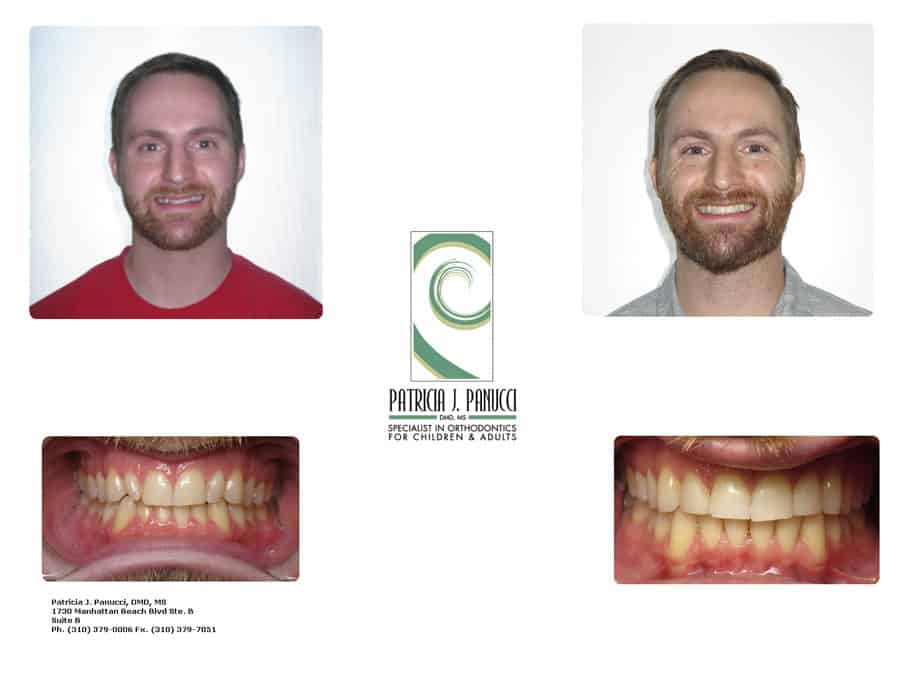 Michael Z before and after orthodontic invisalign treatment