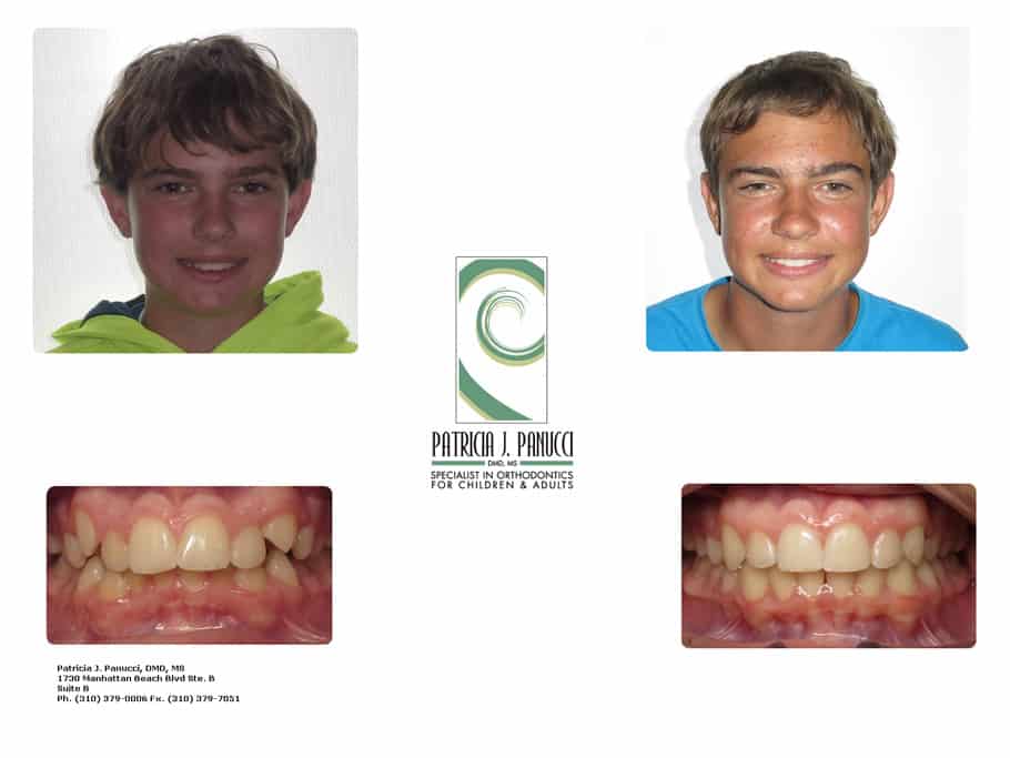 Oliver M before and after orthodontic invisalign treatment