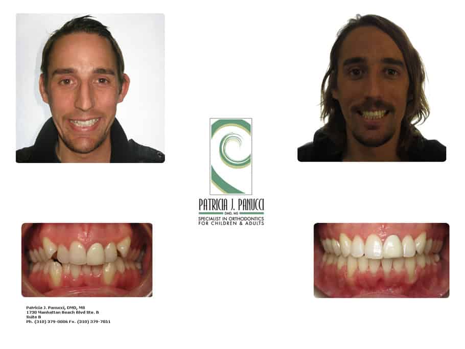 Roy P. before and after orthodontic invisalign treatment
