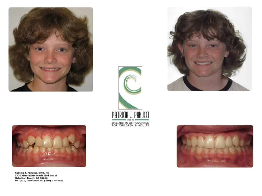 Steven O before and after orthodontic invisalign treatment