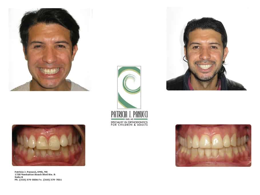 Rey P. before and after orthodontic invisalign treatment