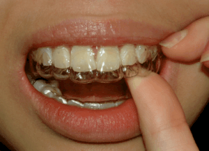 Retainers