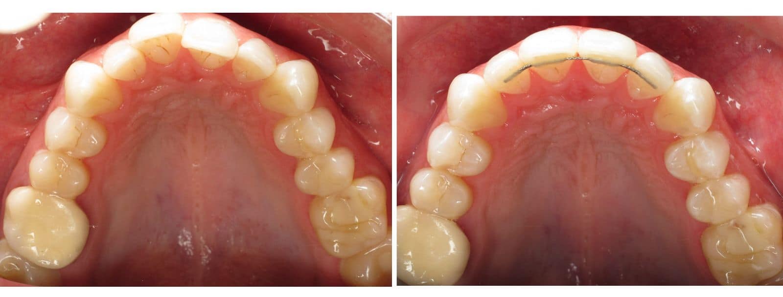 Lingual Braces 1