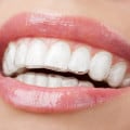 Invisalign, Beach Braces, Orthodontist