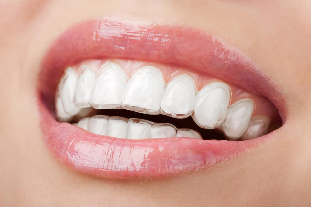 Invisalign, Beach Braces, Orthodontist