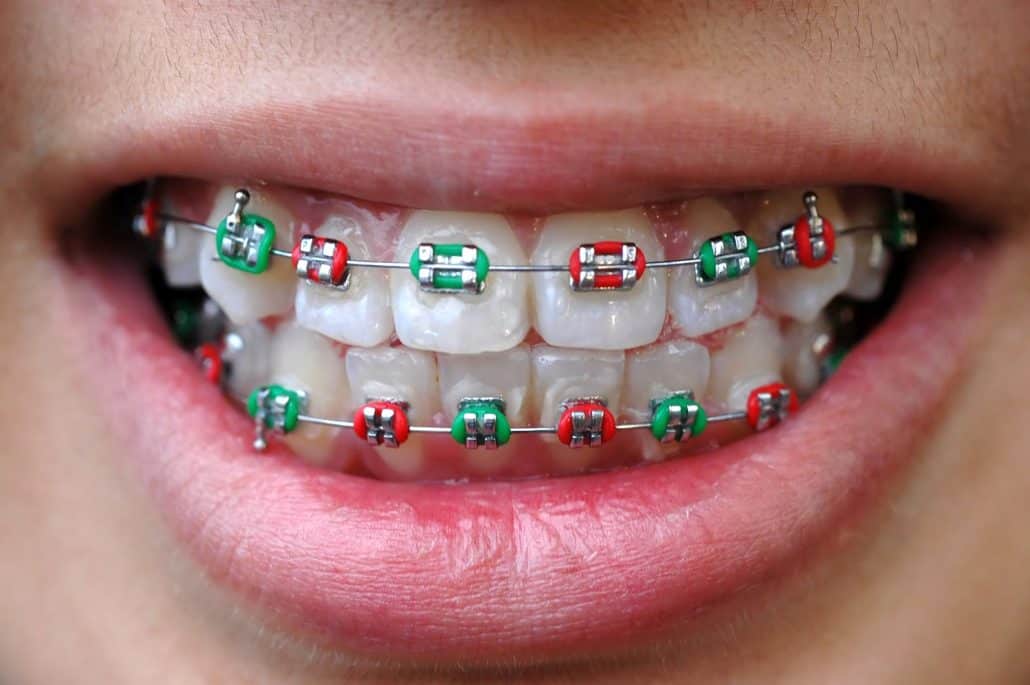 braces colors