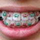 braces colors