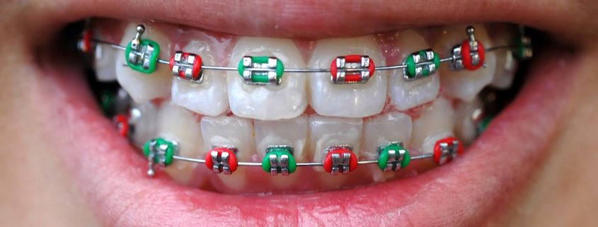 braces colors