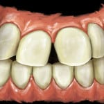 Orthodontics in Manhattan Beach, Receding gums