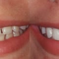 Invisalign, Beach Braces