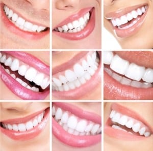 white teeth, invisalign