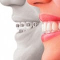 smiles with brackets and invisalign