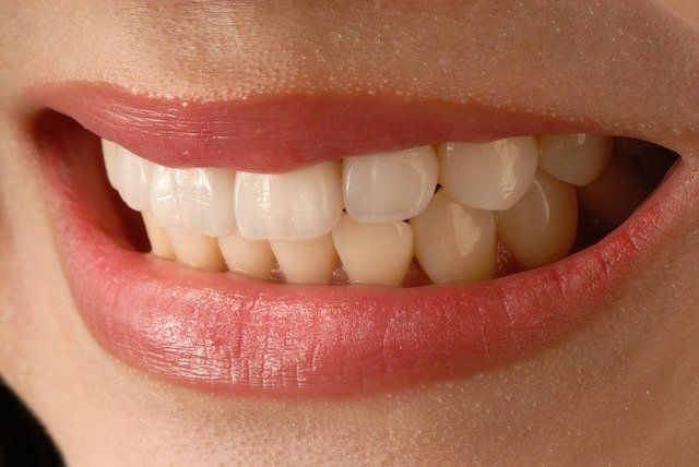 veneers