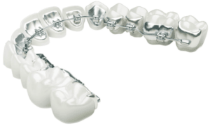 lingual braces