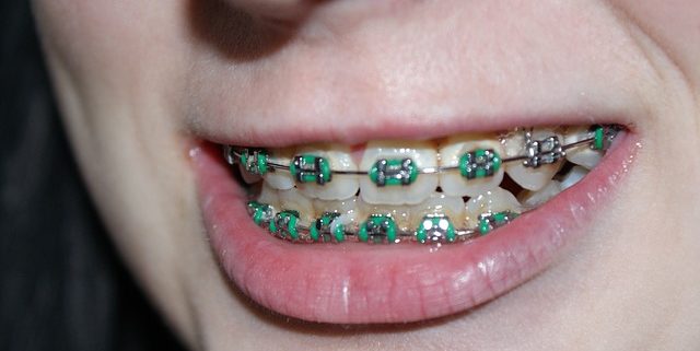 braces close up