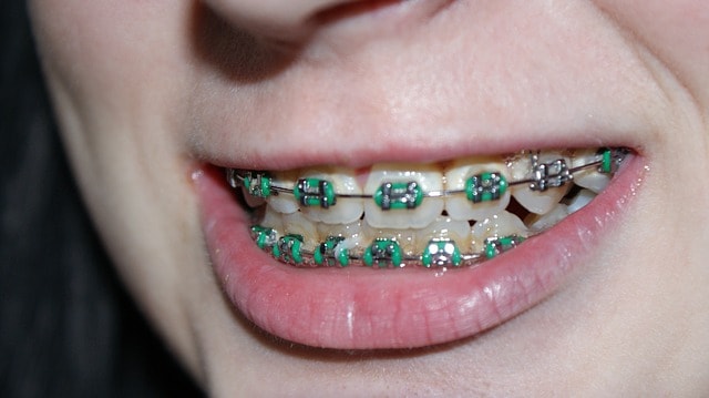 braces close up