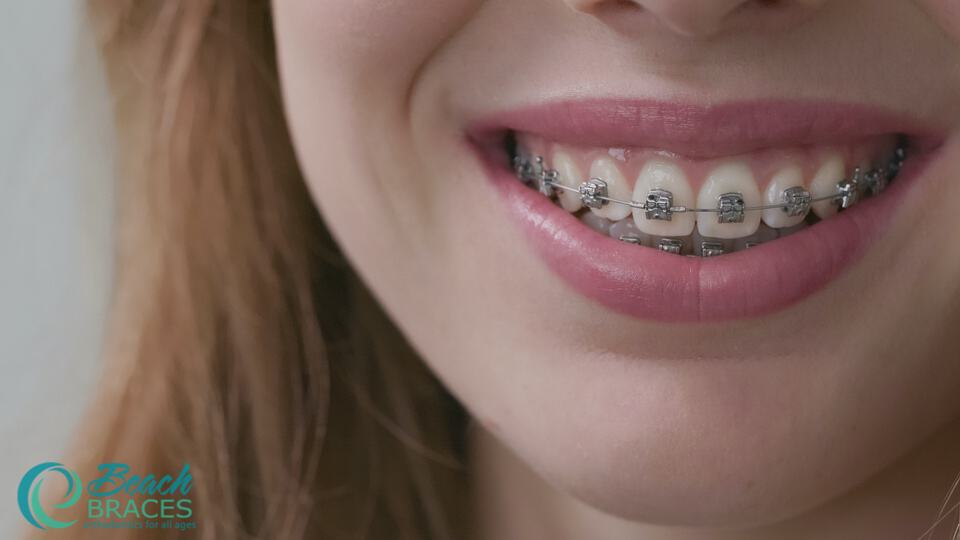 Carriere SLX Model - Self-ligating braces