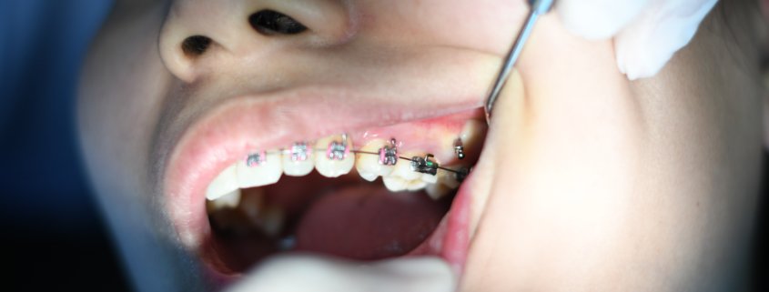 Braces with wisdom teeth