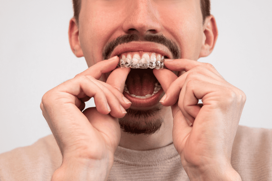 The Hidden Dangers Can Invisalign Lead to Gum Recession? Invisalign
