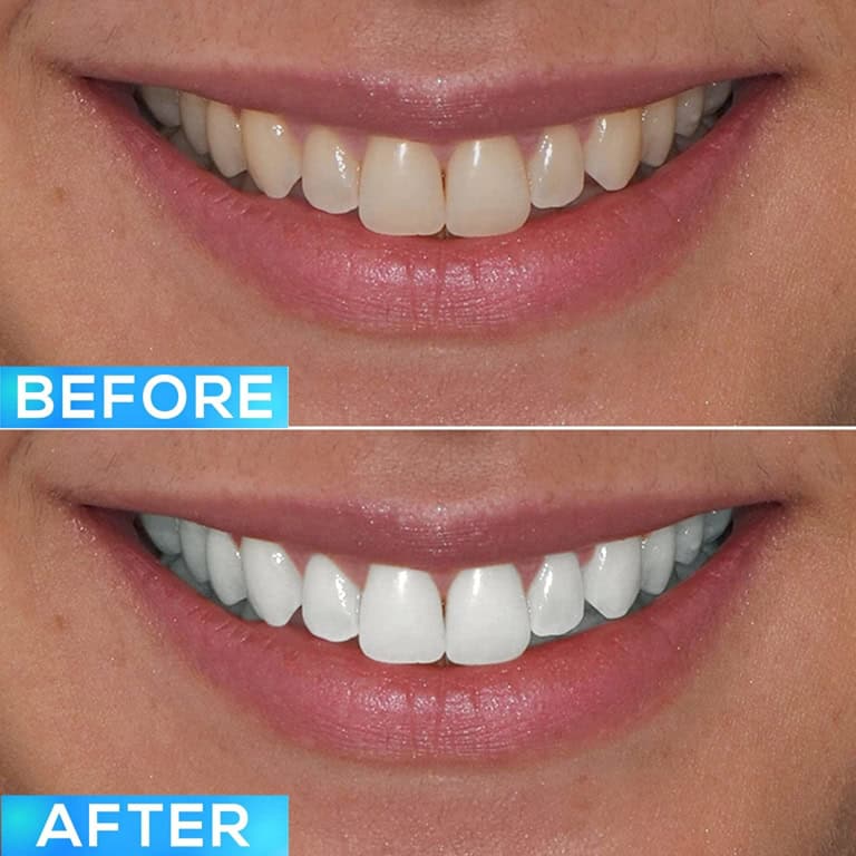 Professional Teeth Whitening GLO Science
