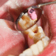 fillings