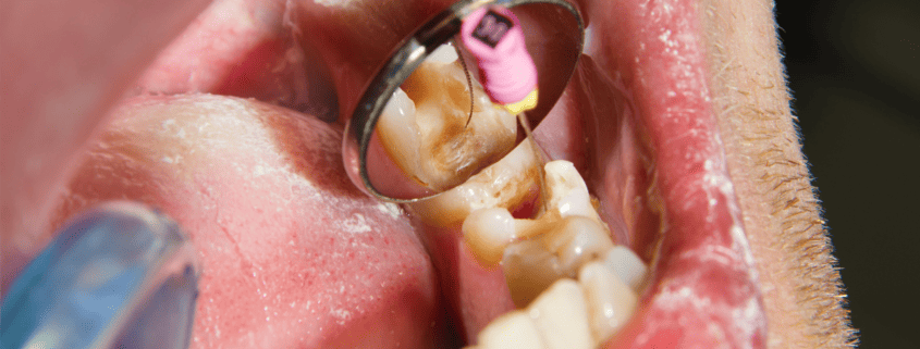 fillings