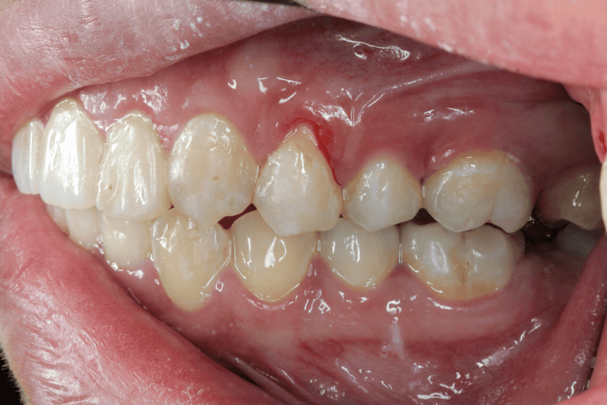 Can Invisalign Cause Gum Recession? (We Answer) Beach Braces