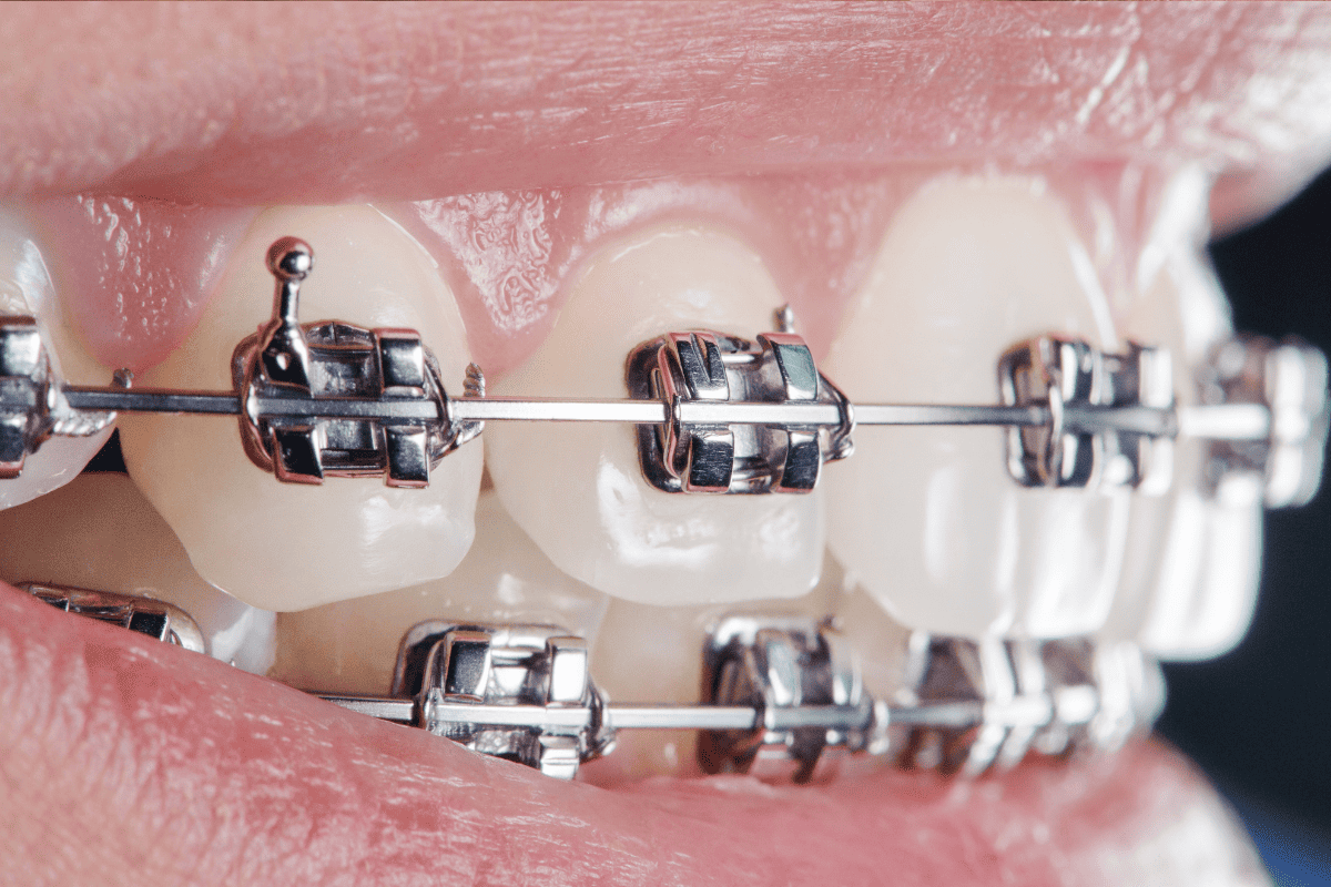 What Are Phase 2 Braces and How Do They Differ From Phase 1 Braces